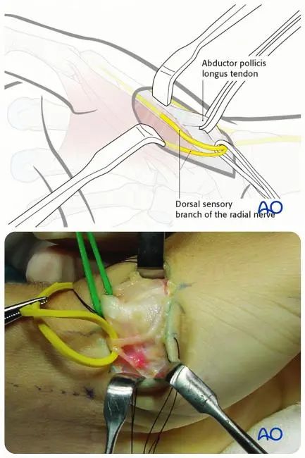 图文详解治疗Bennett骨折的掌侧入路