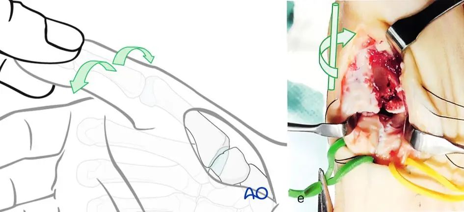 图文详解治疗Bennett骨折的掌侧入路