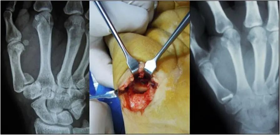 图文详解治疗Bennett骨折的掌侧入路
