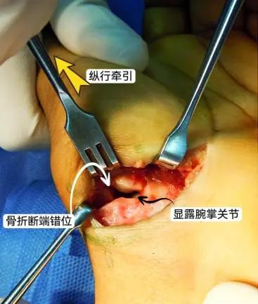 图文详解治疗Bennett骨折的掌侧入路