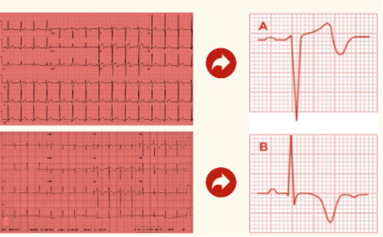 急性冠脉综合征不典型心电图识别