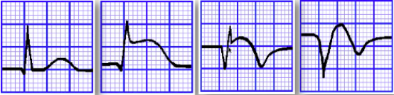 急性冠脉综合征不典型心电图识别