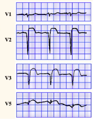 急性冠脉综合征不典型心电图识别