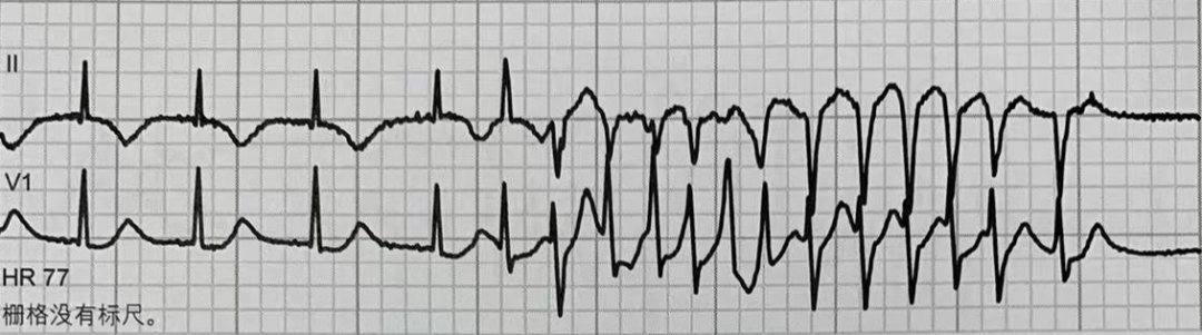 一文看懂尖端扭转型室速的诊断及处理策略