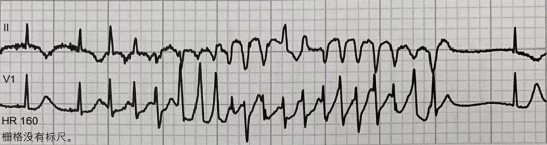 一文看懂尖端扭转型室速的诊断及处理策略