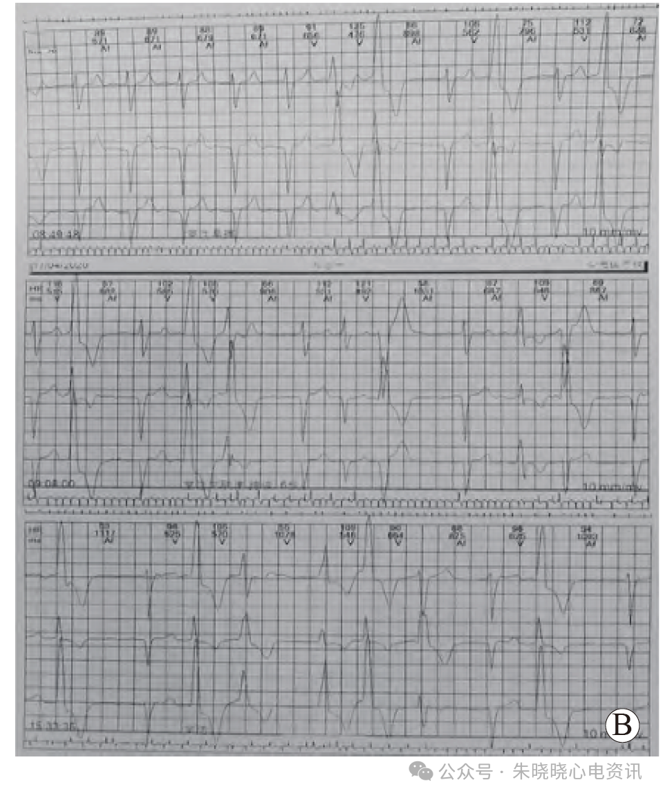 【病例探讨】病态窦房结综合征误诊为心房颤动