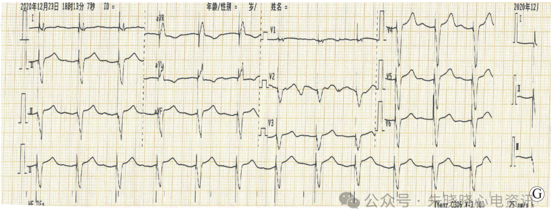 【病例探讨】病态窦房结综合征误诊为心房颤动