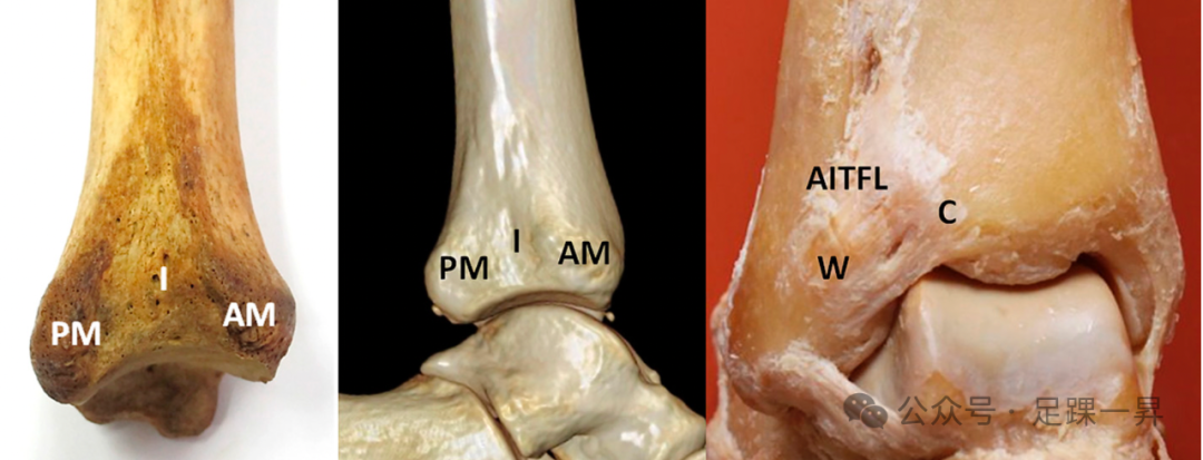 踝关节骨折：Tillaux-Chaput结节骨折的最新分型