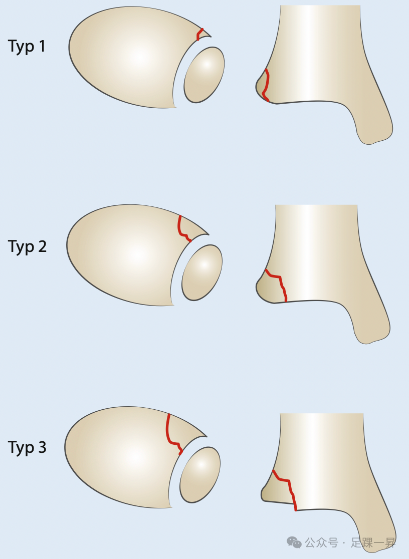 踝关节骨折：Tillaux-Chaput结节骨折的最新分型