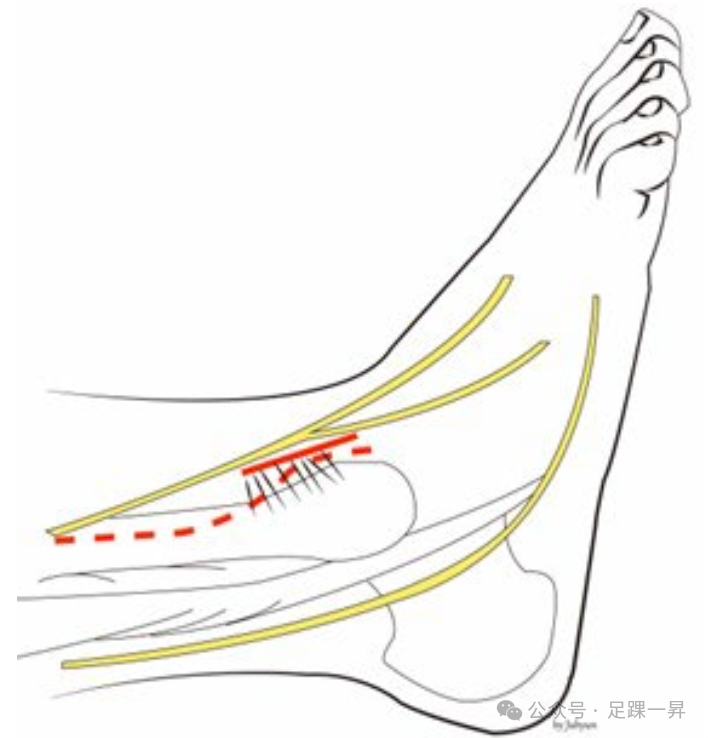 踝关节骨折：Tillaux-Chaput结节骨折的最新分型