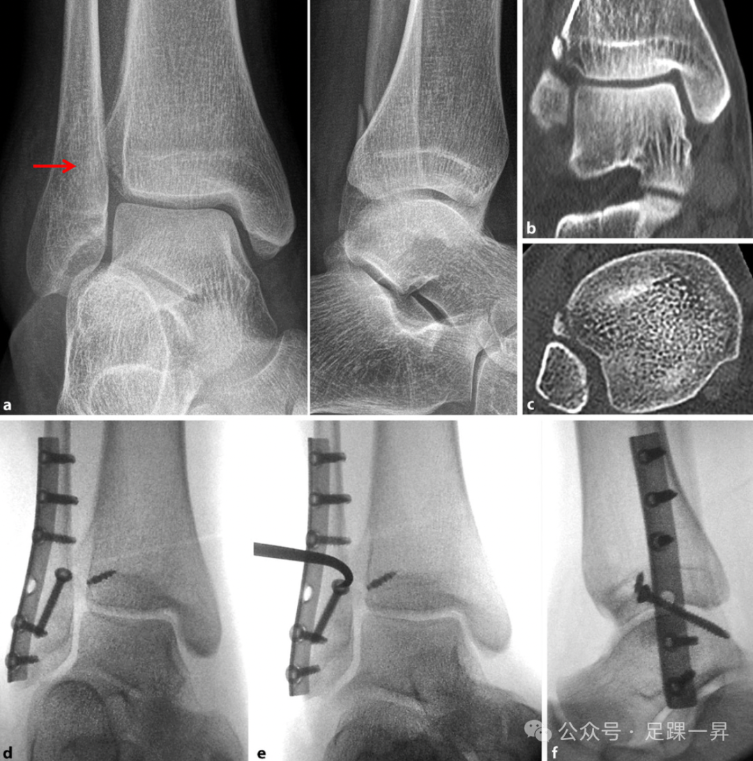 踝关节骨折：Tillaux-Chaput结节骨折的最新分型