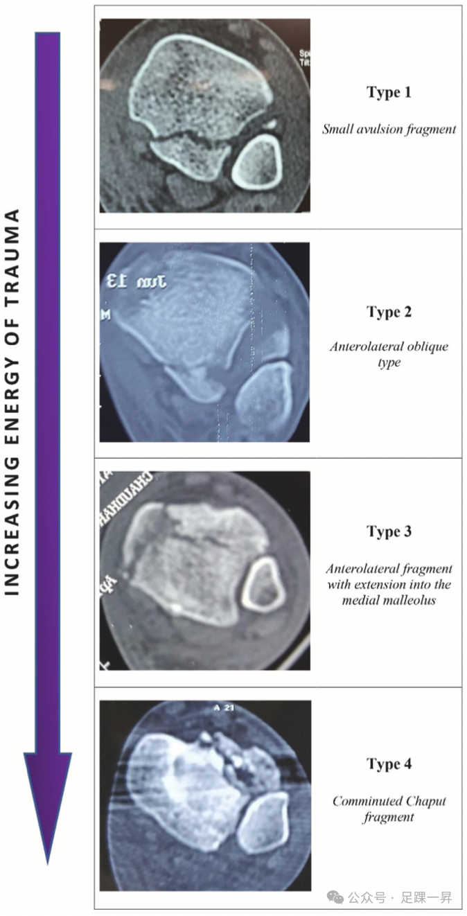 踝关节骨折：Tillaux-Chaput结节骨折的最新分型
