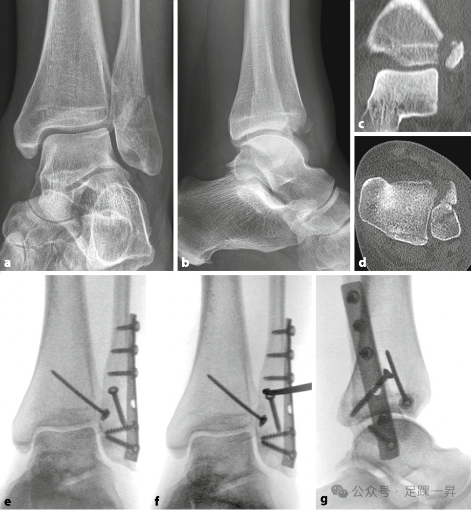 踝关节骨折：Tillaux-Chaput结节骨折的最新分型