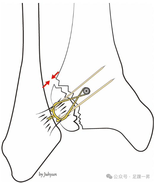 踝关节骨折：Tillaux-Chaput结节骨折的最新分型
