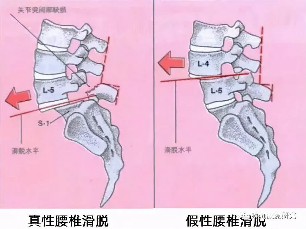 腰椎滑脱的分型、病因、诊断和治疗及锻炼