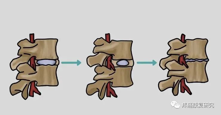 腰椎滑脱的分型、病因、诊断和治疗及锻炼