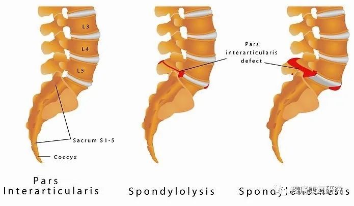 腰椎滑脱的分型、病因、诊断和治疗及锻炼