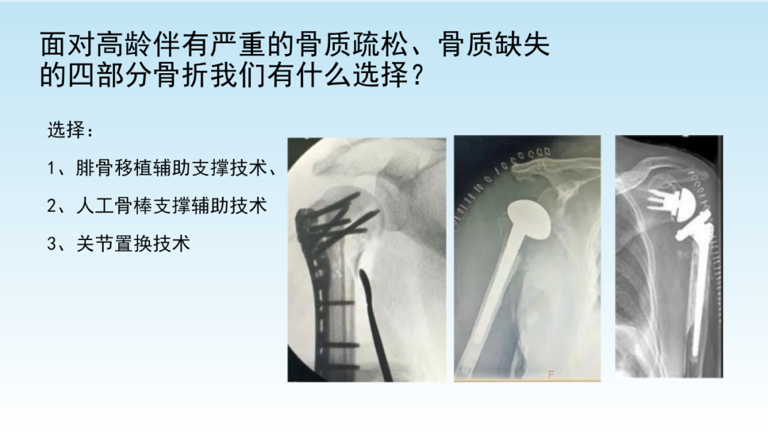 骨水泥辅助技术在骨质疏松性肱骨近端骨折中的应用探索