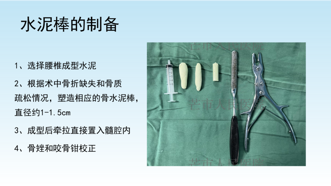 骨水泥辅助技术在骨质疏松性肱骨近端骨折中的应用探索