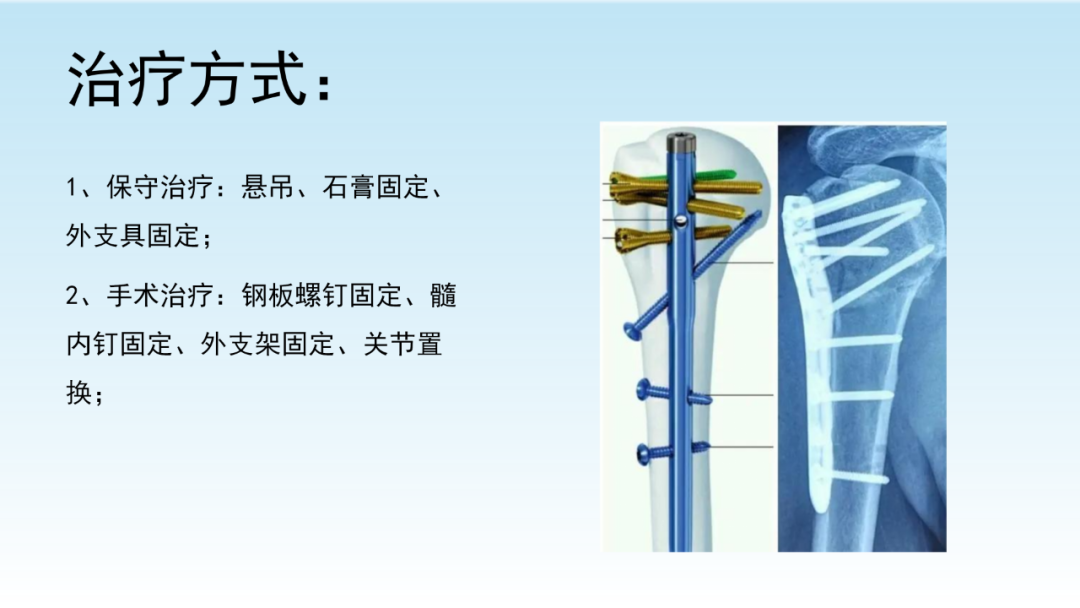 骨水泥辅助技术在骨质疏松性肱骨近端骨折中的应用探索