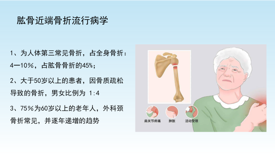 骨水泥辅助技术在骨质疏松性肱骨近端骨折中的应用探索