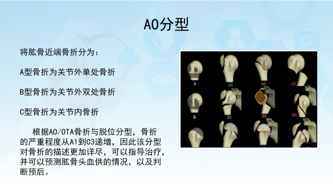 骨水泥辅助技术在骨质疏松性肱骨近端骨折中的应用探索