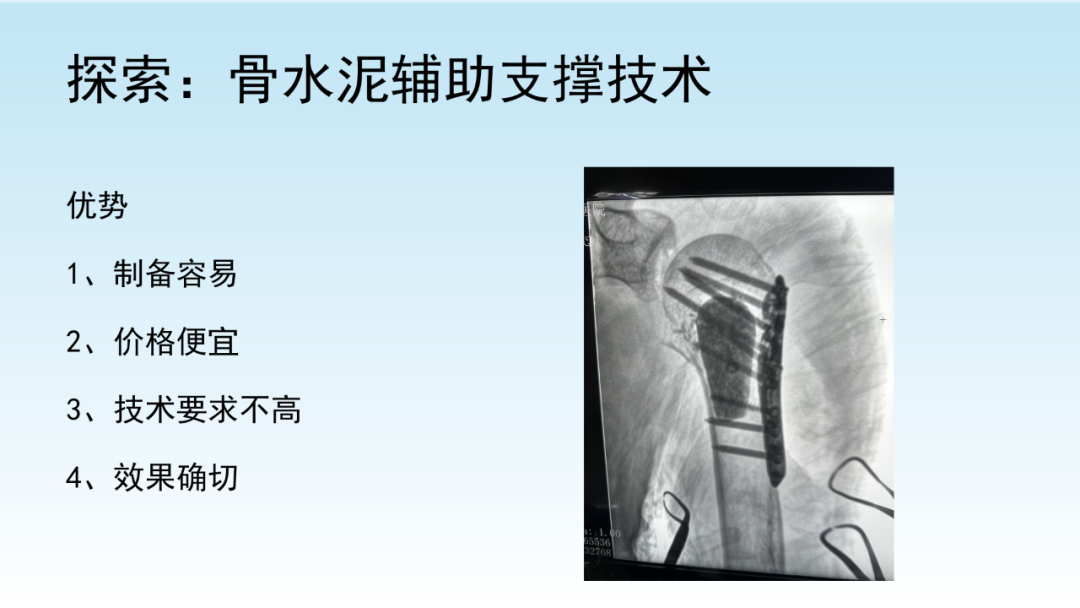 骨水泥辅助技术在骨质疏松性肱骨近端骨折中的应用探索