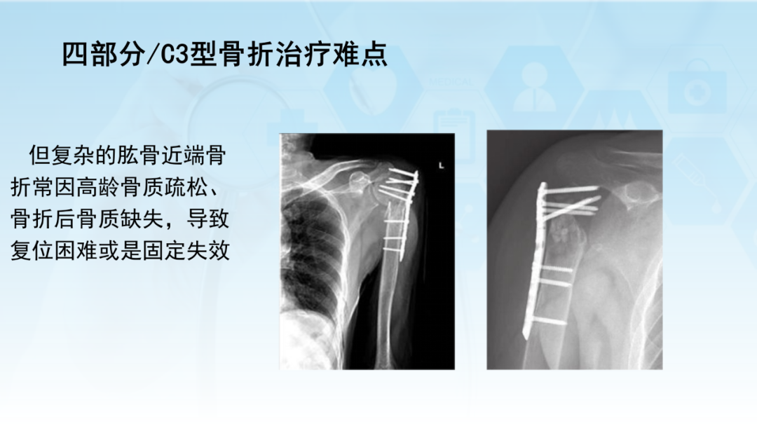 骨水泥辅助技术在骨质疏松性肱骨近端骨折中的应用探索