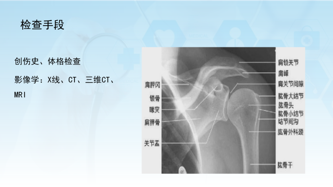 骨水泥辅助技术在骨质疏松性肱骨近端骨折中的应用探索