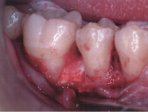 牙周再生治疗技术的临床效果