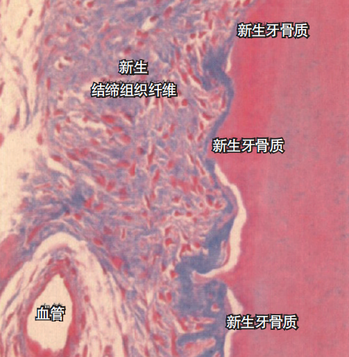 牙周再生治疗技术的临床效果