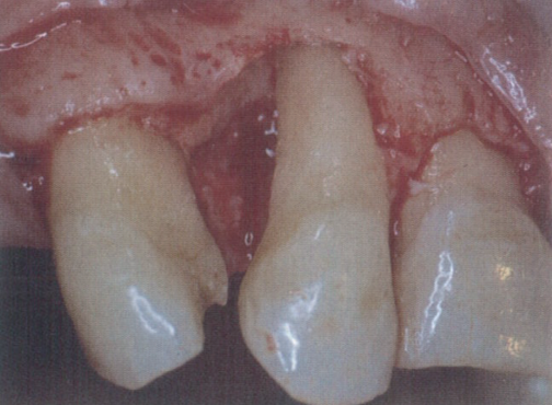 牙周再生治疗技术的临床效果