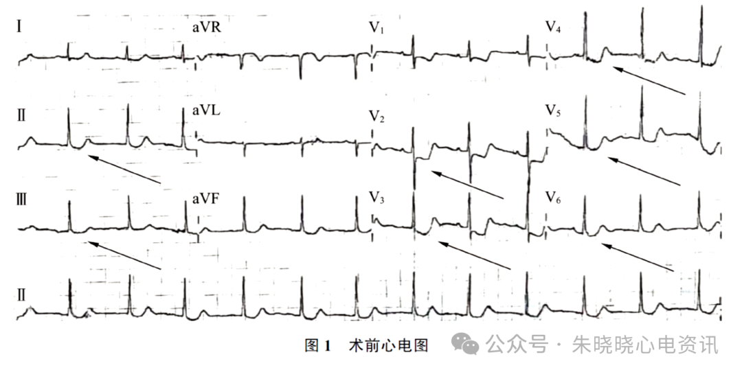 非ST段抬高型急性冠脉综合征鱼钩样心电图表现