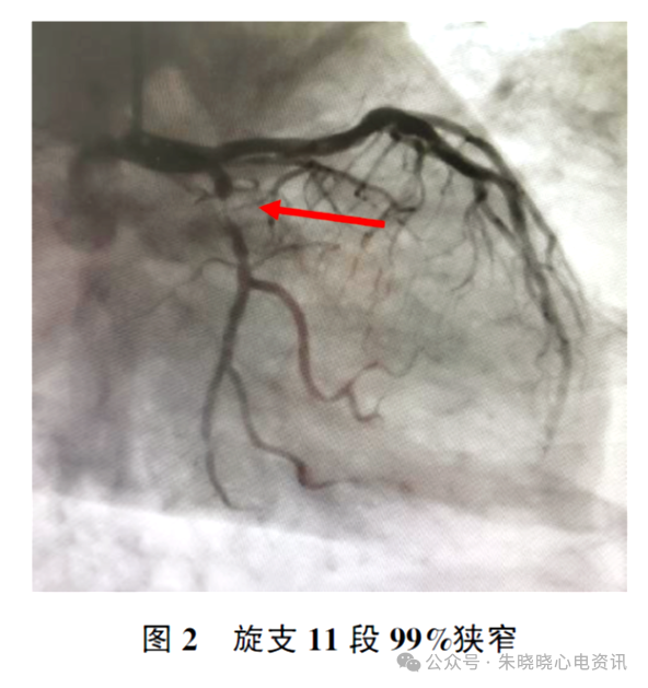 非ST段抬高型急性冠脉综合征鱼钩样心电图表现