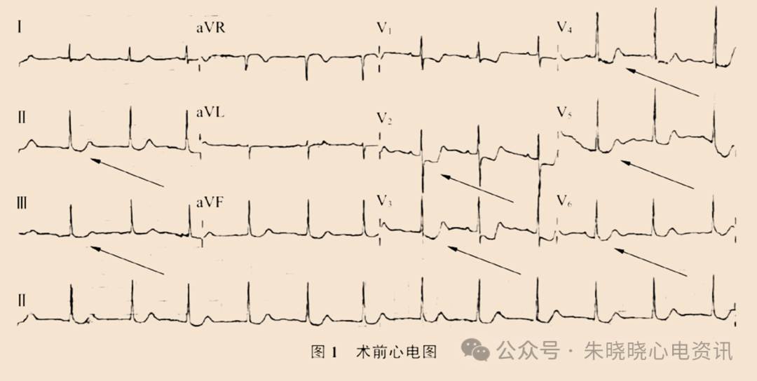 非ST段抬高型急性冠脉综合征鱼钩样心电图表现