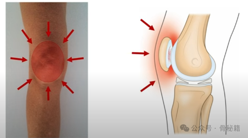 髌骨软化，到底哪里软了？