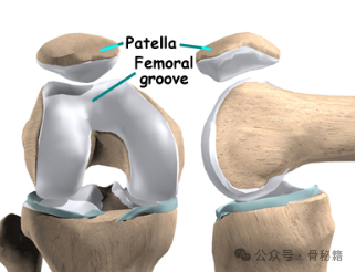 髌骨软化，到底哪里软了？