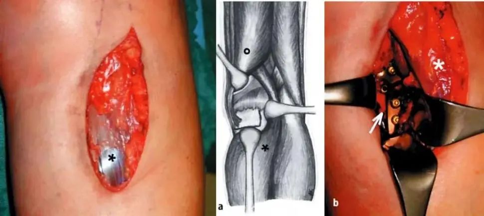 图文并茂：详解Lobenhoffer入路治疗胫骨后内侧平台骨折(ORIF)