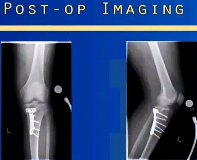 图文并茂：详解Lobenhoffer入路治疗胫骨后内侧平台骨折(ORIF)