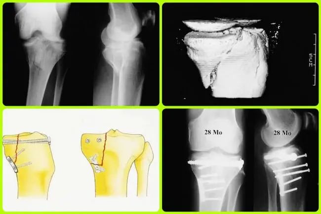 图文并茂：详解Lobenhoffer入路治疗胫骨后内侧平台骨折(ORIF)