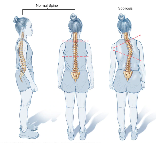 一文了解结构性脊柱侧凸（Structural