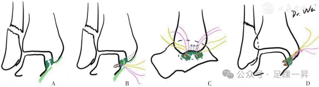 踝关节骨折：急性三角韧带断裂锚钉修复技术
