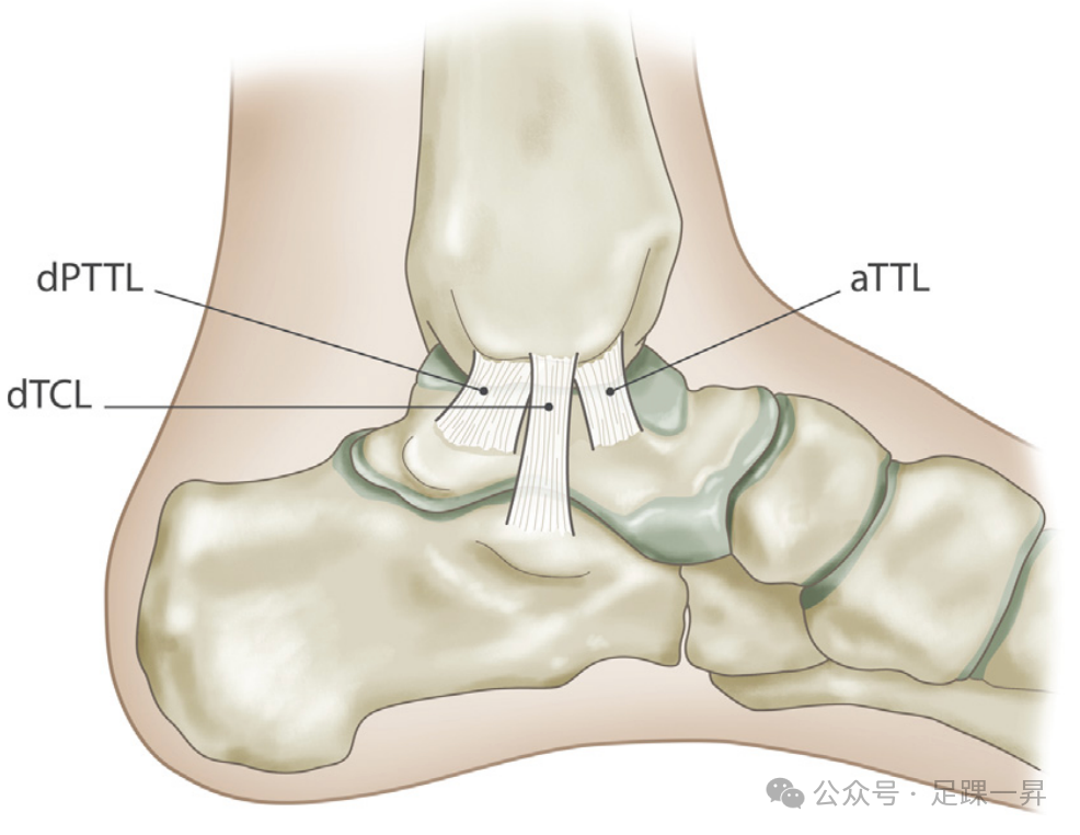 踝关节骨折：急性三角韧带断裂锚钉修复技术