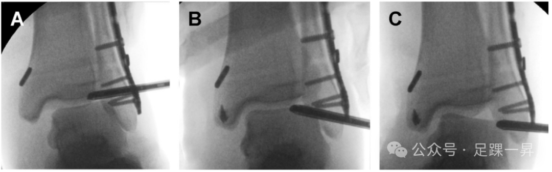 踝关节骨折：急性三角韧带断裂锚钉修复技术