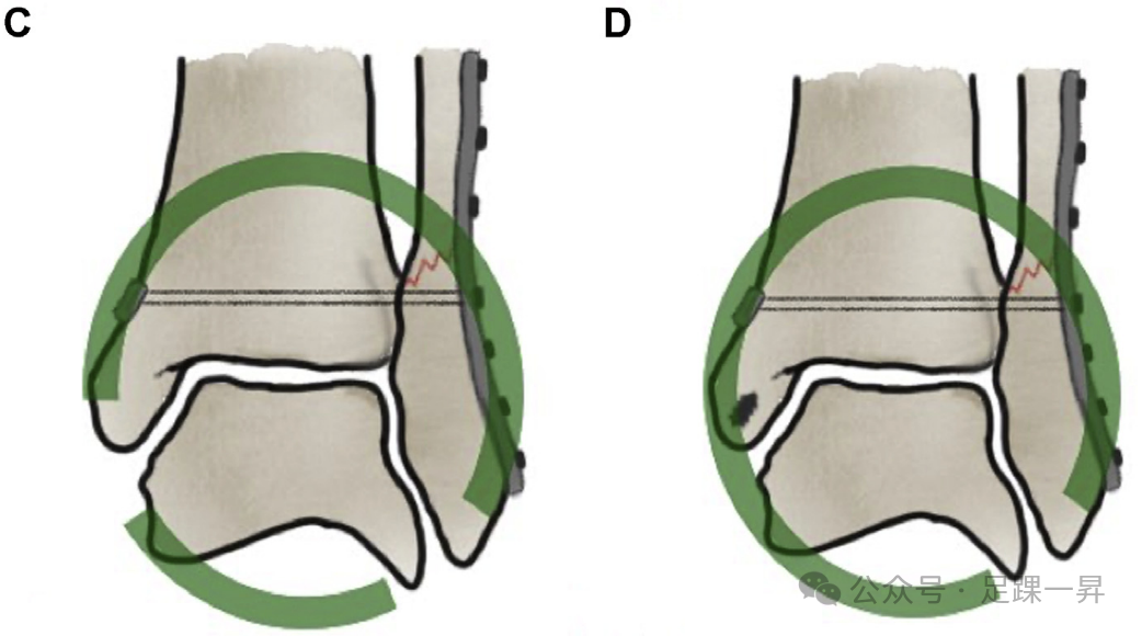 踝关节骨折：急性三角韧带断裂锚钉修复技术
