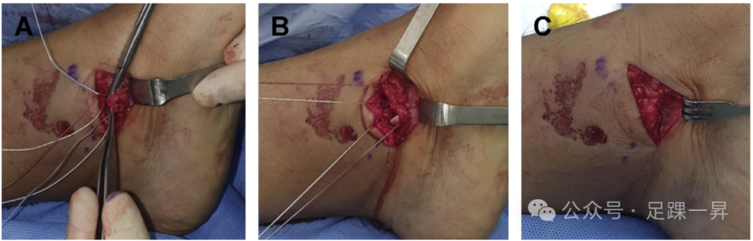 踝关节骨折：急性三角韧带断裂锚钉修复技术