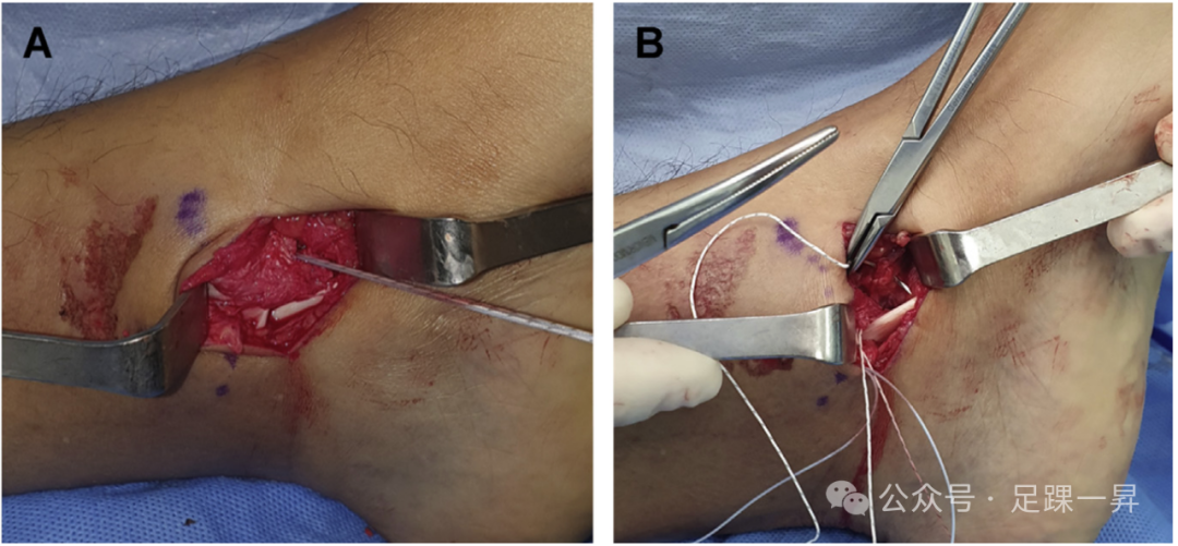 踝关节骨折：急性三角韧带断裂锚钉修复技术