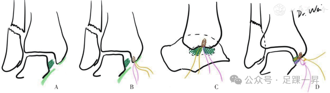 踝关节骨折：急性三角韧带断裂锚钉修复技术