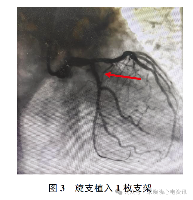 非ST段抬高型急性冠脉综合征鱼钩样心电图表现