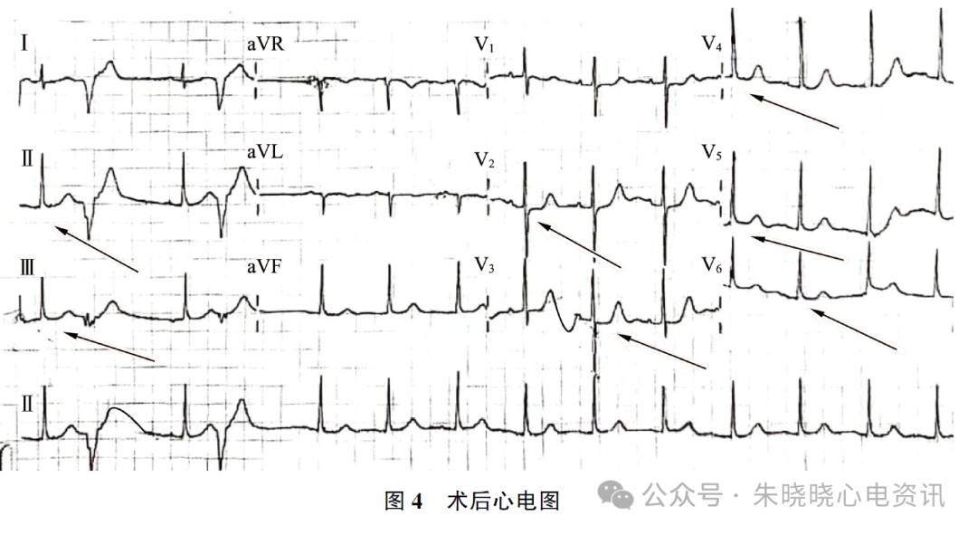 非ST段抬高型急性冠脉综合征鱼钩样心电图表现